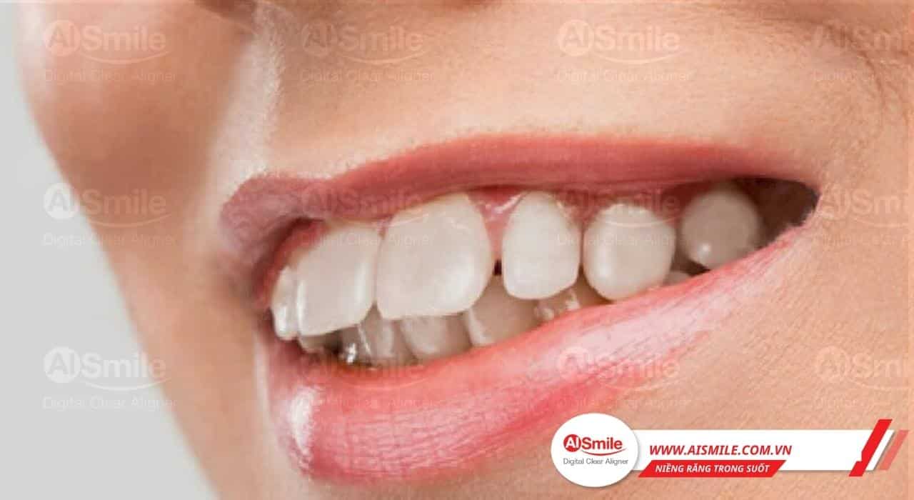 Chi phí niềng răng hô nhẹ là bao nhiêu tại AI Smile?