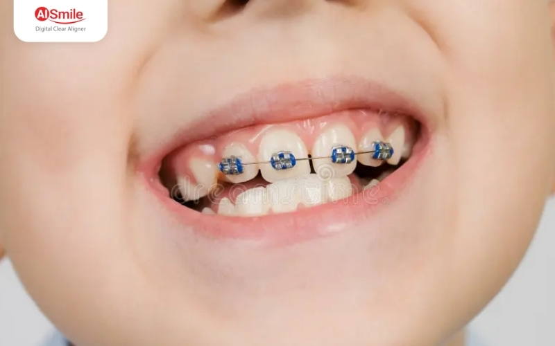 Niềng 2 răng cửa – Giải pháp chỉnh nha tập trung, nhanh chóng và hiệu quả.