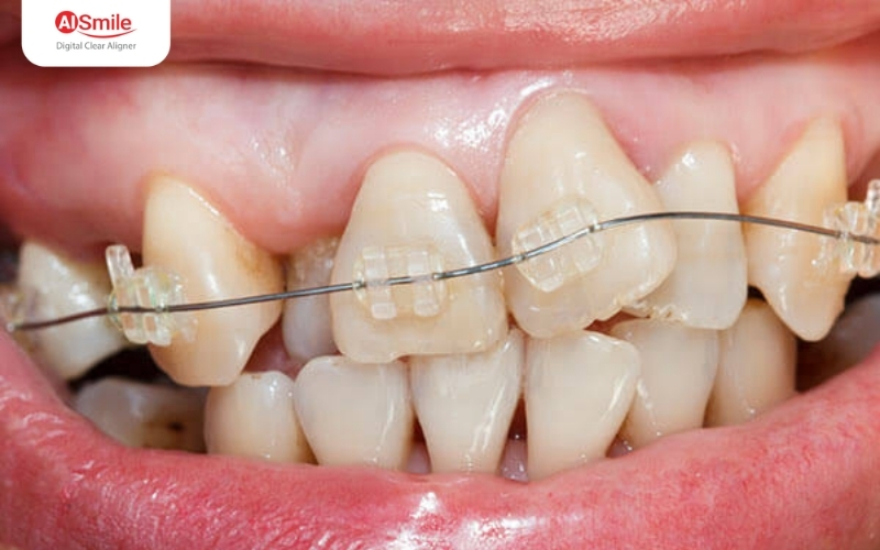 Mắc cài sứ: Tinh tế, thẩm mỹ, khó phát hiện khi giao tiếp.