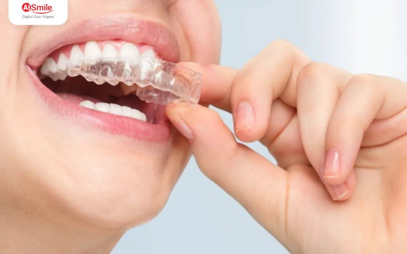 Để đạt kết quả tốt nhất, bạn cần duy trì thói quen đeo khay đều đặn mỗi đêm và vệ sinh khay sạch sẽ ngay sau khi thức dậy.