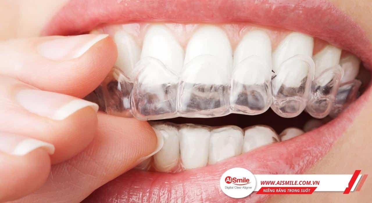 Chi phí niềng răng trong suốt và mắc cài có khác nhau không?