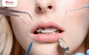 Niềng 2 Răng Cửa: Bí Quyết Sở Hữu Nụ Cười Hoàn Hảo